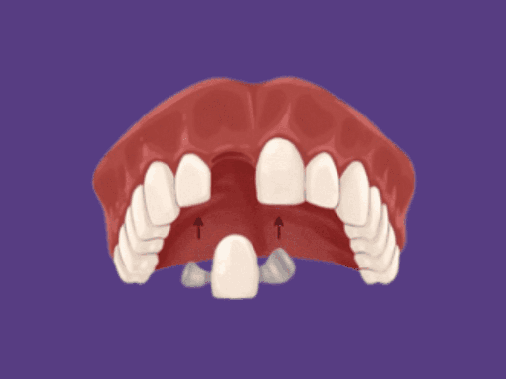 ¿Qué es un puente dental?